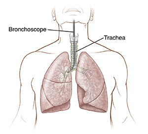 Front view of trachea, bronchi, and lungs with flexible bronchoscope in trachea.