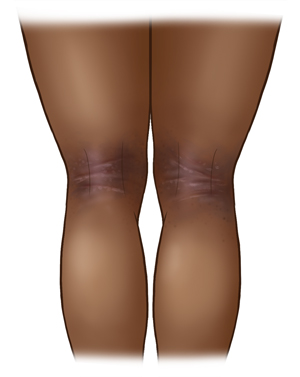 Back view of dark-skinned legs from showing eczema in the creases behind the knees. 