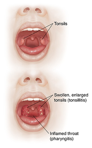 Front view of face with open mouth comparing oral cavity and tonsils with inflamed throat and enlarged tonsils.