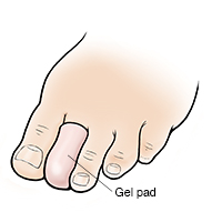 Foot with gel pad on seond toe.