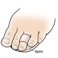 Foot with splint on third toe.