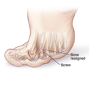 Bottom view of flexed foot showing metatarsal realigned to help heal plantar callus on ball of foot.