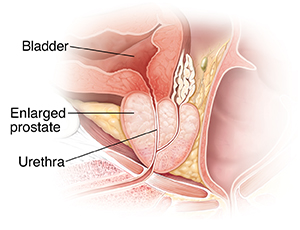 Cross section of enlarged prostate gland.