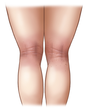 Back view of light-skinned legs with eczema in the creases behind the knees. 