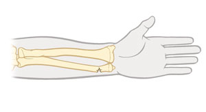 Lower arm bones showing greenstick fracture of wrist.