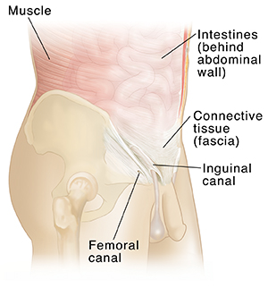 Side view of male torso showing abdominal muscles and intestines ghosted in. Umbilical ring and internal inguinal ring are visible.