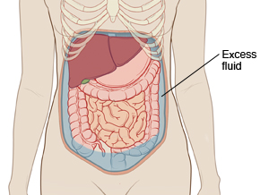 Outline of woman's abdomen showing abdominal organs. Fluid is filling abdomen around organs. 