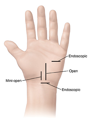 Palm of hand with incision sites for carpal tunnel surgery.