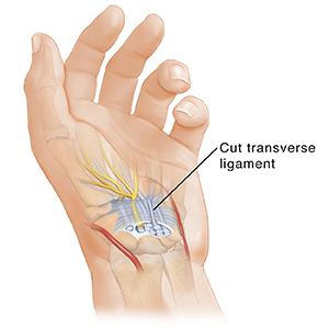 Hand with palm up, showing carpal tunnel anatomy and cut ligament.