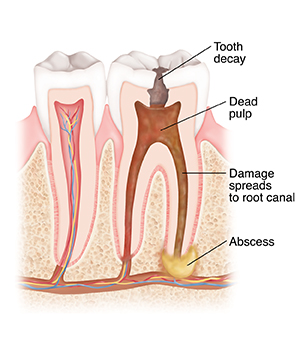 Cross section of tooth with decay, dead pulp, abscess, and damage that spread to root canal.