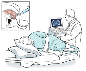 Healthcare provider performing transrectal ultrasound on male patient.