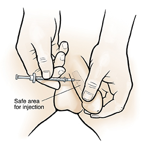 Man injecting medication into penis.