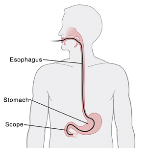 Upper body showing endoscope inserted through mouth to stomach.