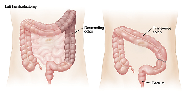 Outline of adult abdomen showing large and small intestines. Shaded area on left image shows left hemicolectomy. Outline of abdomen showing transverse colon attached to sigmoid colon after left hemicolectomy.