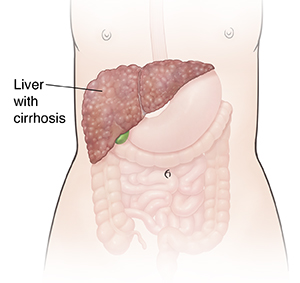 Front view of person's outline showing digestive system and liver with cirrhosis.