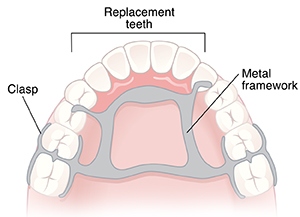 Roof of mouth and teeth showing partial denture.