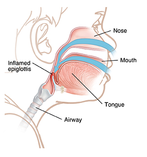 Side view of child's head showing throat anatomy with inflamed epiglottis.