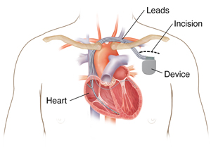 Outline of man's chest showing showing biventricular implantable cardioverter defibrillator in chest with three leads going into heart chambers.