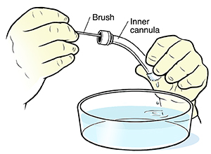 Hands pushing cleaning brush through tracheostomy tube over bowl of water.