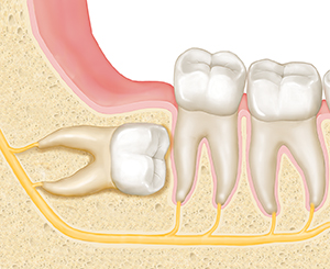 Teeth in cross section of jawbone. Wisdom tooth is in bone under gum, pointing forward to roots of next tooth.