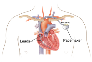 Outline of man's chest showing pacemaker in chest with leads going into heart chambers.