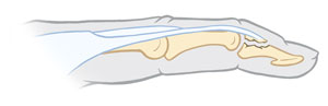 Side view of finger with avulsion fracture.