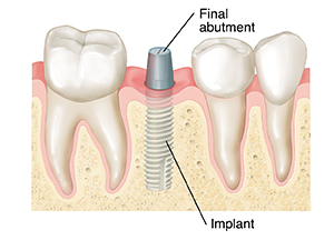 Teeth in cross section of gum and jawbone. Implant is in bone, and abutment is attached to implant above gum.