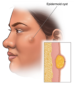 Side view of woman's head showing epidermoid cyst. Inset shows cross section of epidermoid cyst.