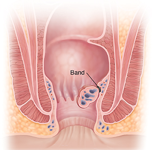 Cross section of anus showing banded hemorrhoid.