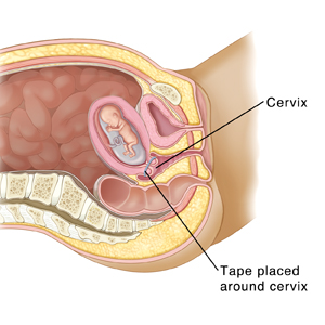 Cross section side view of woman's pelvis showing baby developing in uterus. Band is around cervix to hold it closed.