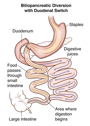 Front view of stomach showing biliopancreatic diversion with duodenal switch. Arrows show path of food and digestive fluids.