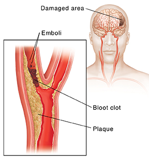 Blood clot blocking carotid artery and emboli breaking off clot. Inset shows damage to brain.