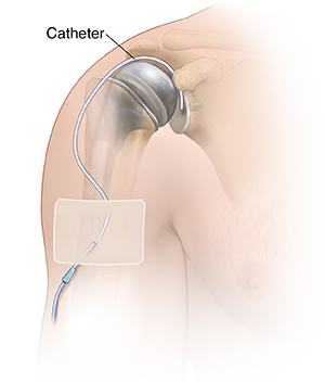 Front view of upper arm showing catheter inserted into shoulder joint.