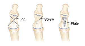 Front view of fractured bone showing three ways to close fracture: pins, screw, and plate.
