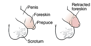 Side view of boy's penis and scrotum showing foreskin and prepuce on penis. Side view of boy's penis and scrotum showing retracted foreskin.
