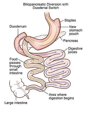 Front view of stomach showing biliopancreatic diversion with duodenal switch. Arrows show path of food and digestive fluids.