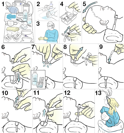 Thirteen steps for changing a child's tracheostomy.