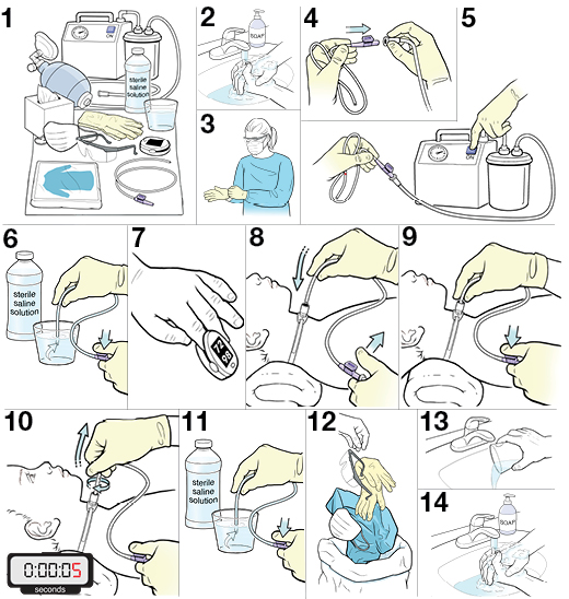 Step by step instruction of how to replace a child’s tracheostomy tube.