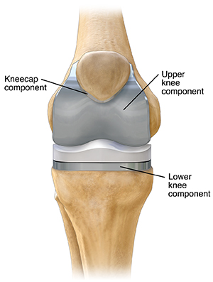 Front view of knee with prosthesis.