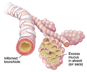 Bronchiole and alveolar sacs with mucus buildup and inflammation because of pneumonia.