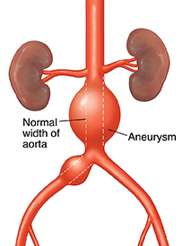 Front view of abdominal aorta with aneurysms. Dotted line shows normal width of aorta.