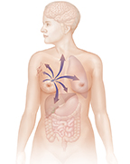 Outline of woman from head to mid-thigh. Arrows show breast cancer spreading to multiple organs.