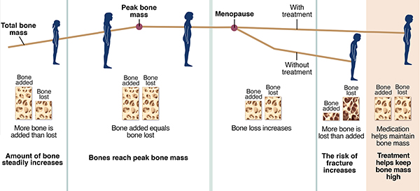 Graph showing bone growth and loss over woman's lifespan, with and without treatment for osteoporosis.