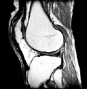 MRI scan of the knee.
