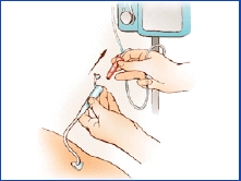 Imagen de una sonda de alimentación