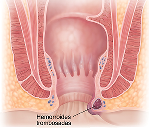 Corte transversal del ano donde pueden verse hemorroides trombosadas.