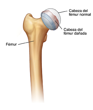 Vista frontal de la parte superior del fémur con la cabeza femoral dañada. La línea punteada muestra la forma redondeada de una cabeza femoral normal.