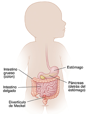 Contorno de un niño donde puede verse el sistema digestivo y un divertículo de Meckel.