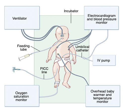 Top view of baby in incubator showing neonatal intensive care unit equipment.