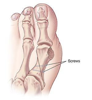 Top view of big toe showing screws holding bones together after bunion base osteotomy. 